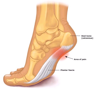 Try Massage for Plantar Fasciitis Treatment